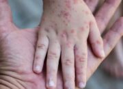 Cacar Monyet Jadi Keadaan Darurat Kesehatan Global Menurut WHO