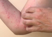 Panduan untuk Masyarakat, Cara Penularan dan Pencegahan Mpox